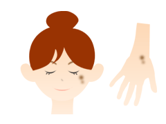 老人性色素斑(日光シミ)